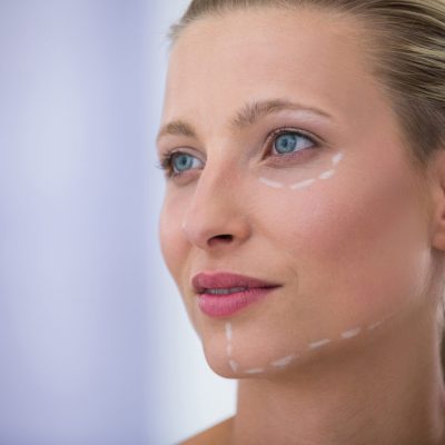 Close-up of woman with marks drawn for cosmetic treatment
